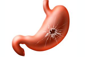 Ilustración de Cómo evitar los síntomas de la gastritis