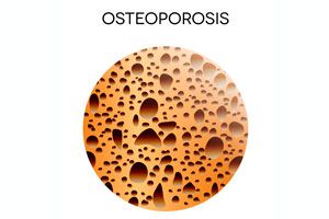 Ilustración de Cómo alimentarnos para prevenir la osteoporosis