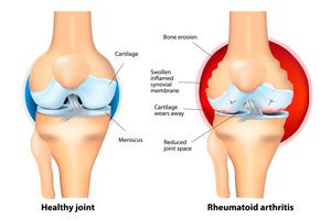 Ilustración de Cómo se produce la artritis