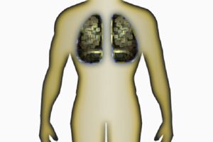 Ilustración de El cáncer de pulmón