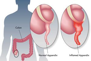 Ilustración de Síntomas de la apendicitis