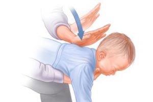 Ilustración de Pasos a seguir cuando un niño o bebe se asfixia por atragantamiento