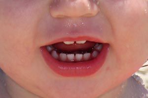 Ilustración de Golpes, caries y problemas que pueden cambiar el color de los dientes del niño